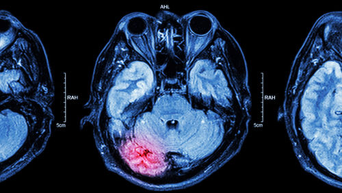 brain scan compumedics magnetoencephalography asx:cmp hot stock
