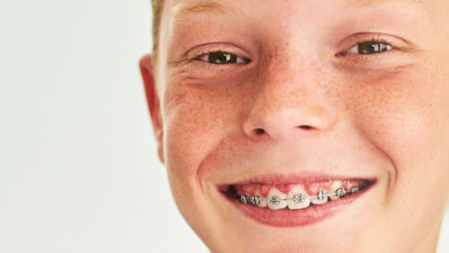 how to afford braces for kids