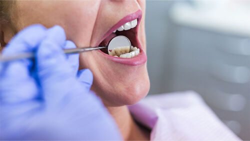The stubbornly high cost of a trip to the dentist can make it tempting to dip into your nest egg. But unnecessary fees, high taxes and rip-off treatments mean a $20,000 withdrawal could cost you over $100,000 in the long run.